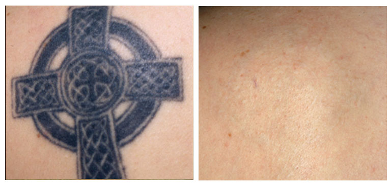North Houston Laser Tattoo Removal, Remove Tattoos by Laser | http ...