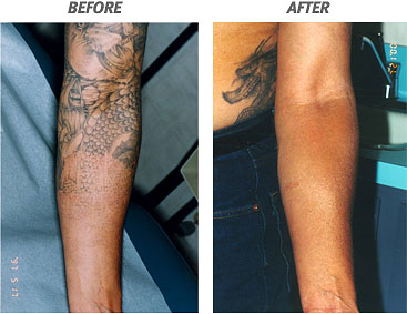 North Houston Laser Tattoo Removal, Remove Tattoos by ...