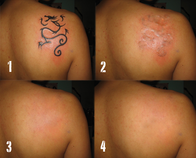 What to Expect from Laser Tattoo Removal, Get My Tattoo ...