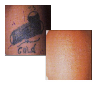 Laser Tatto Removal on Tattoo Removal