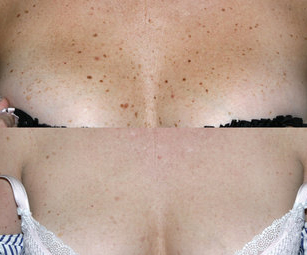 Remove Brown Spots Face http://northhoustonlasertattooremoval.com/skin ...