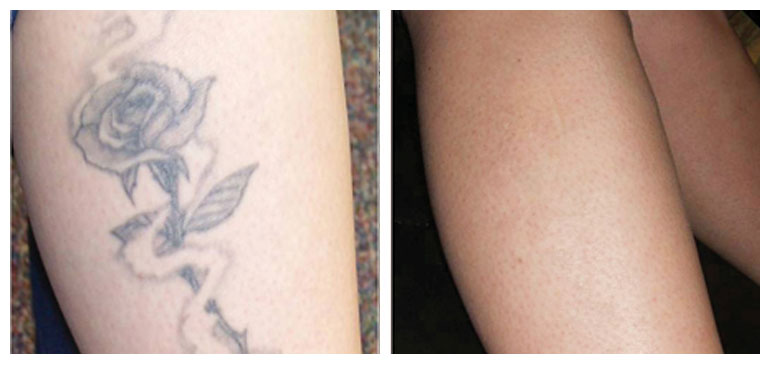 Before and After tattoo removal