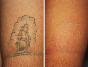 Laser-Tattoo-Removal