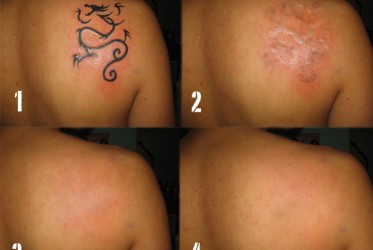 Steps to Tattoo Removal