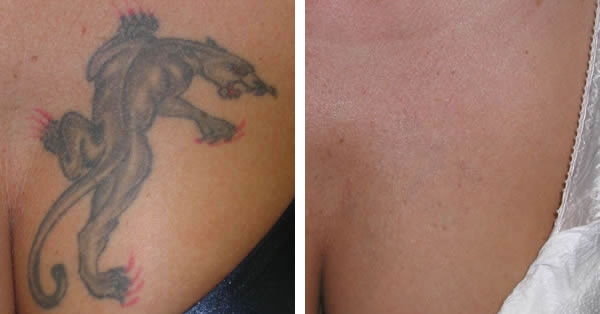 After Care Tattoo Removal