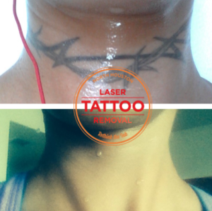 Tattoo Removal from Neck