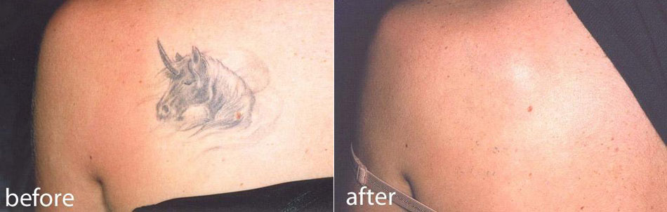 Body Restore The Woodlands Closed  Referring Tattoo Removal  North  Houston Laser Tattoo Removal