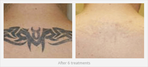 Laser Tattoo and Birthmark Removal Cost in Ludhiana Punjab India