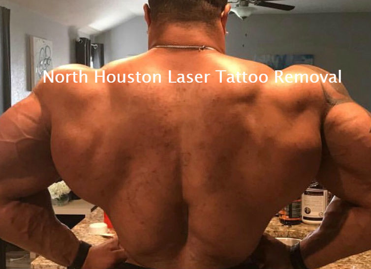 Full Back Tattoo Removed from Body Builder