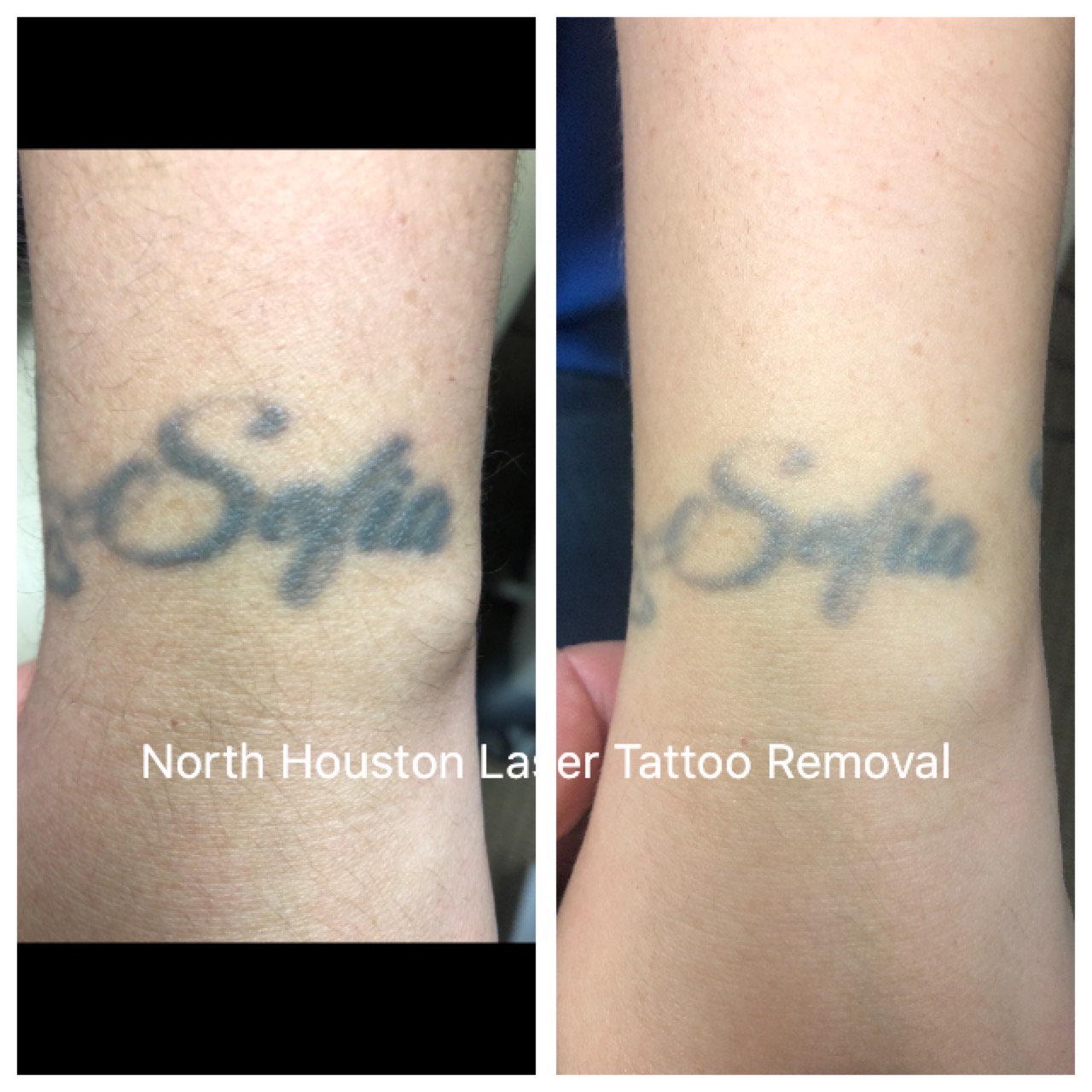 How long will it take before I see my tattoo fade? | North Houston Laser  Tattoo Removal